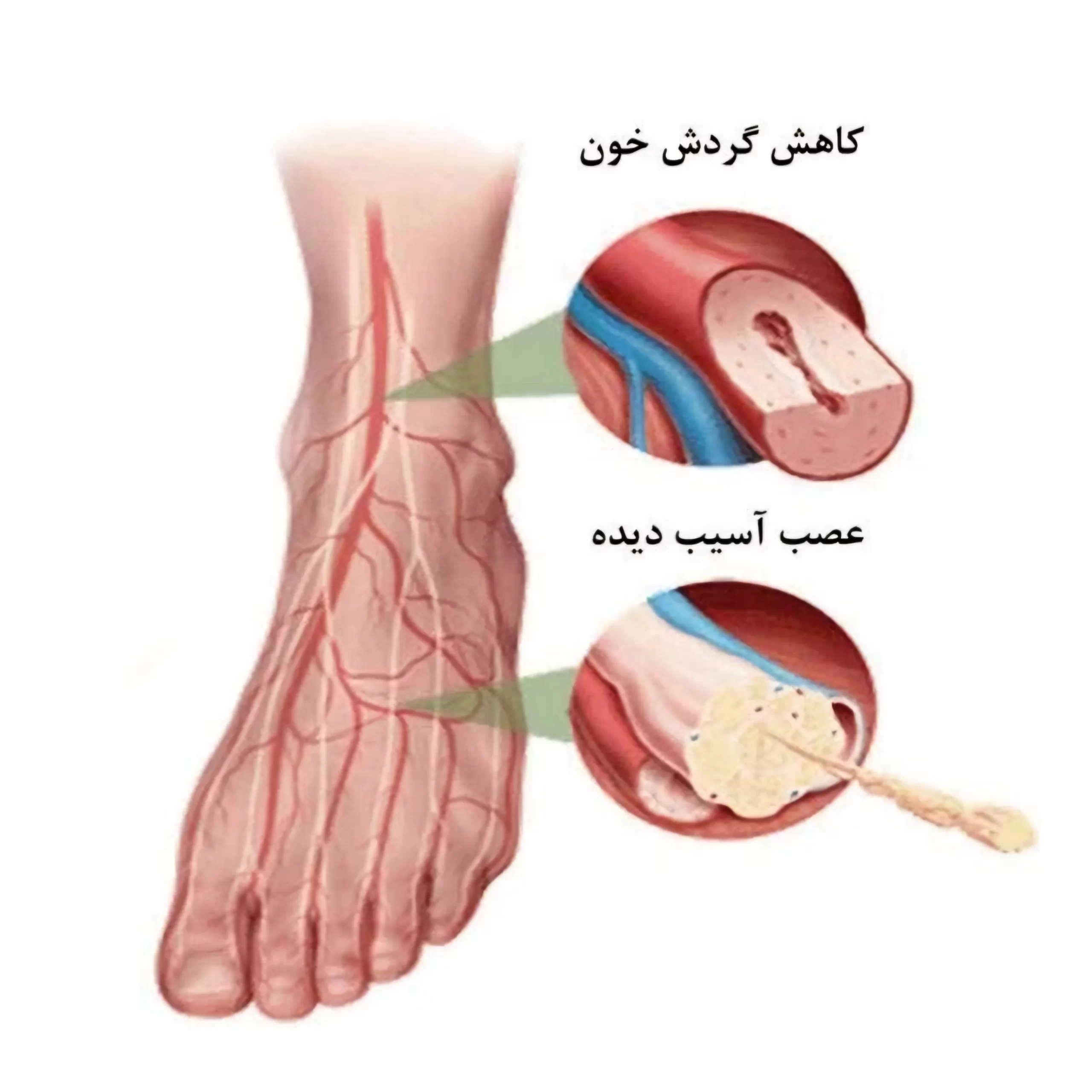 درمان نوروپاتی/ علایم نوروپاتی/ علل نوروپاتی