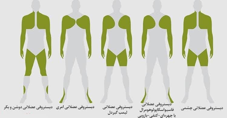 میوپاتی ارثی/ میوپاتی ژنتیکی/ دیستروفی عضلانی