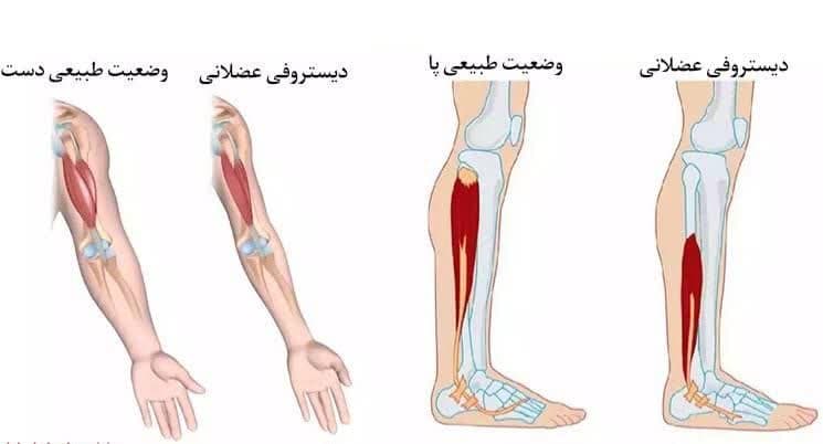 دیستروفی عضلانی/ درمان میوپاتی/ ضعف عضلانی