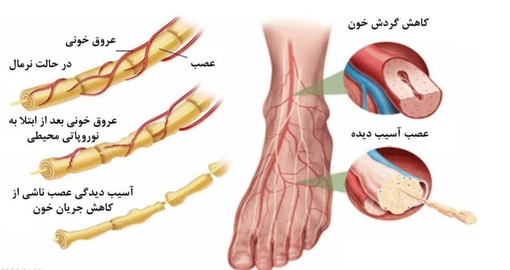 درمان نوروپاتی/ علائم نوروپاتی