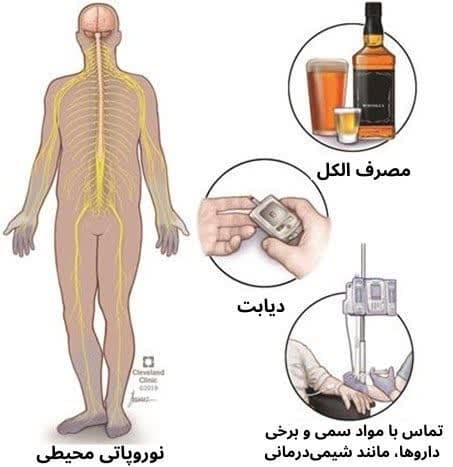 علل ابتلا به نوروپاتی/ علایم نوروپاتی