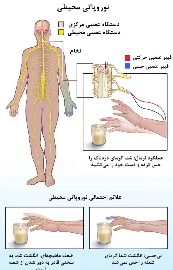 نوروپاتی/ نوروپاتی دیابتی