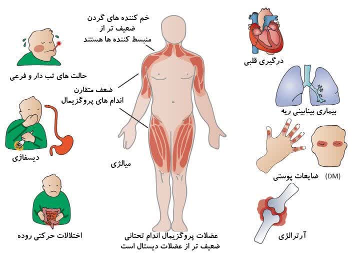 نشانه های میوپاتی/ ضعف عضلانی/ کاردرمانی میوپاتی