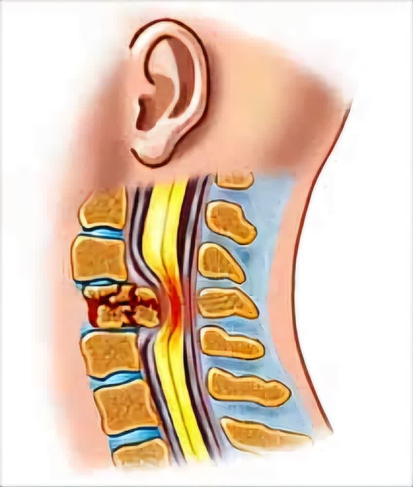 آیا قطع نخاع گردن درمان دارد