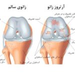 درمان آرتروز زانو