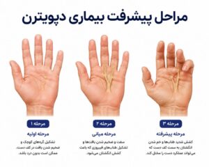 همه‌چیز درباره بیماری دوپویترن: علائم، علل و بهترین روش‌های درمان